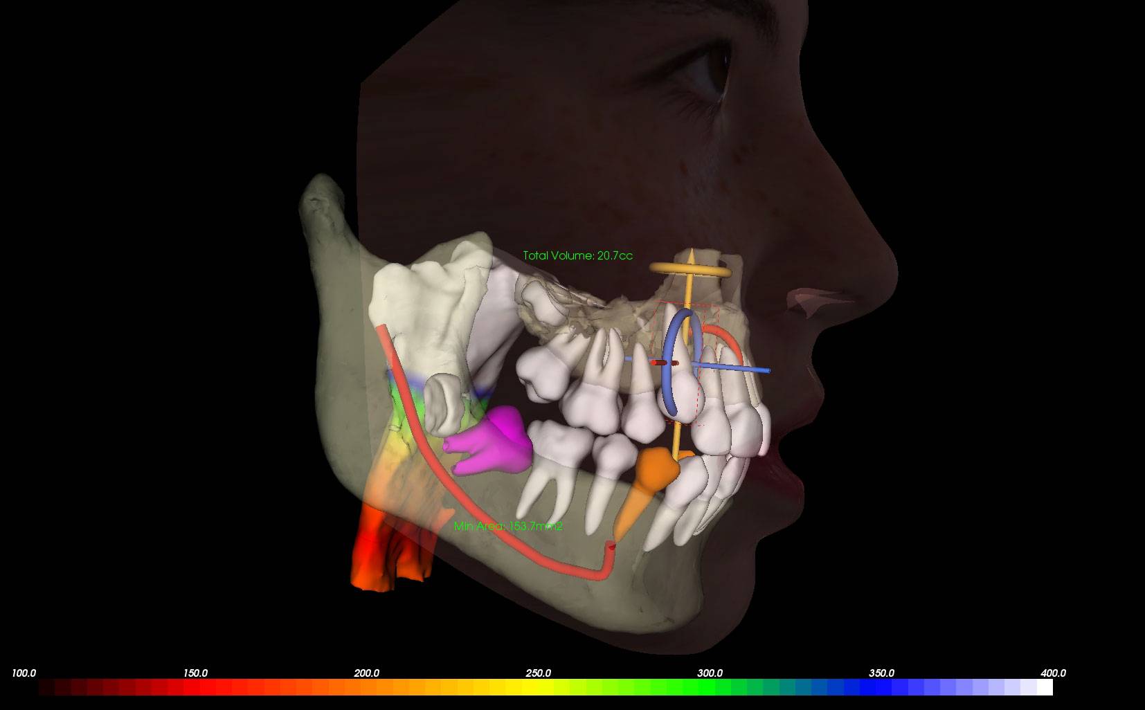 airway treatment using interactive 3D orthodontic models