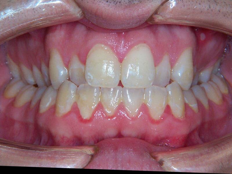 Patient 2 Teeth Before