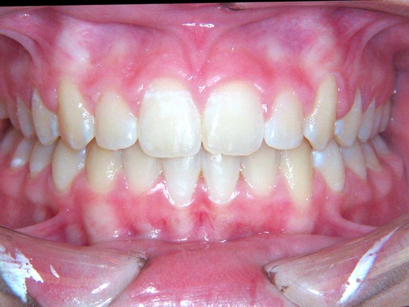 Patient 3 Teeth After