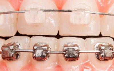 Braces inside teeth vs outside