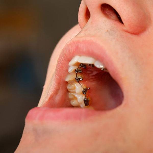 What are braces behind the teeth for?