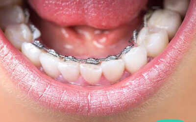 Home Q 1 Are Lingual Braces the Invisible Solution You’ve Been Searching For?